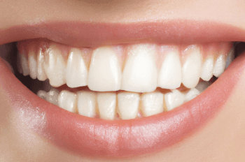 close up of a smile showing teeth and lips